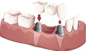 مزایای ایمپلنت دندانی