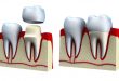 افزایش طول تاج دندان شکسته