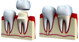 جراحی افزایش طول تاج