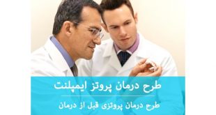 انواع طرح درمان های ایمپلنت